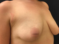 Breast Augmentation