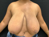 Breast Reduction