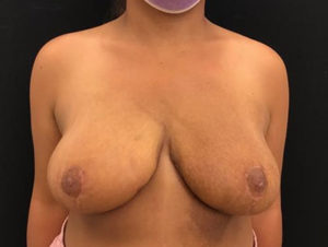 Breast Reduction