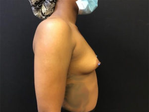 Breast Augmentation