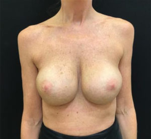 Breast Implant Revision