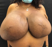 Breast Reduction