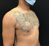 Gynecomastia