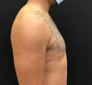 Gynecomastia