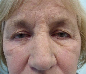 Upper Eyelid Blepharoplasty