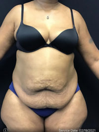 Tummy Tuck