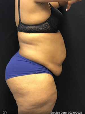 Tummy Tuck
