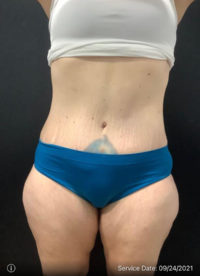 Tummy Tuck