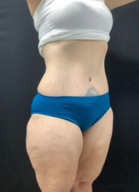 Tummy Tuck