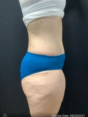 Tummy Tuck