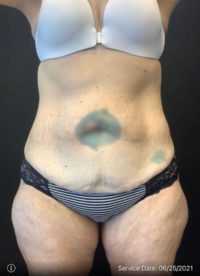 Tummy Tuck