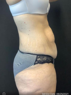 Tummy Tuck