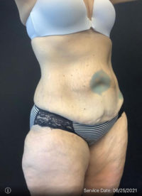 Tummy Tuck