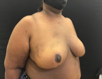 Breast Reduction