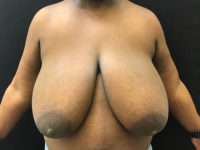 Breast Reduction