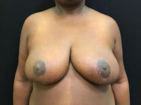 Breast Reduction