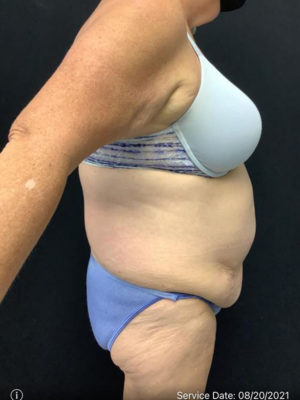 Tummy Tuck