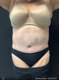 Tummy Tuck