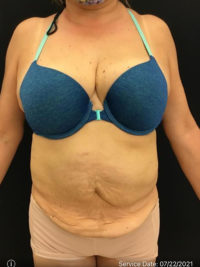 Tummy Tuck