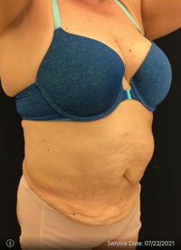 Tummy Tuck