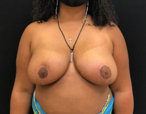 Breast Reduction