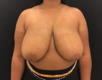 Breast Reduction