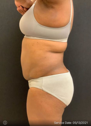 Liposuction