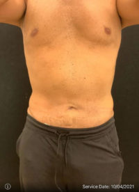 Tummy Tuck