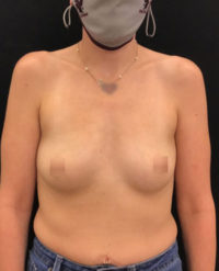 Breast Augmentation