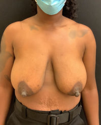 Breast Lift