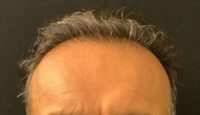 Neograft Hair transplantation