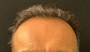 Neograft Hair transplantation