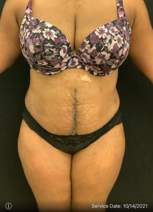 Tummy Tuck