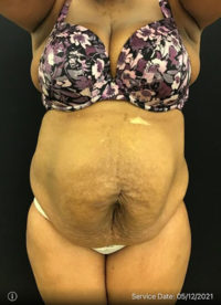 Tummy Tuck