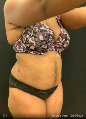 Tummy Tuck