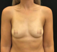 Breast Augmentation