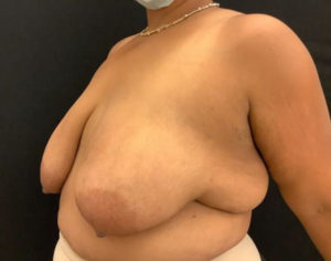 Breast Reduction