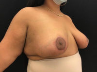 Breast Reduction