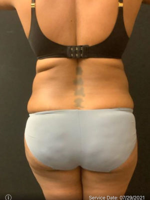 Liposuction