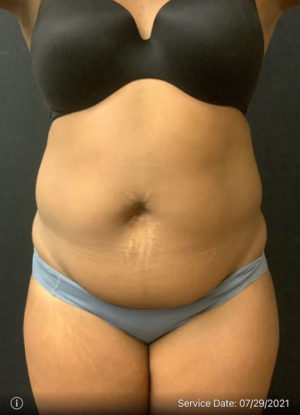 Liposuction