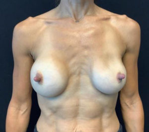 Breast Implant Revision