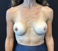 Breast Implant Revision