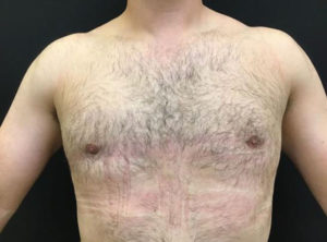 Gynecomastia