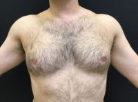 Gynecomastia