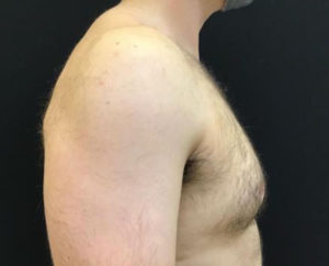 Gynecomastia