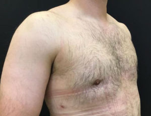 Gynecomastia