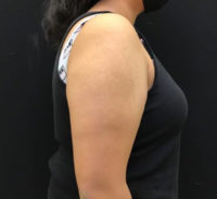 Liposuction
