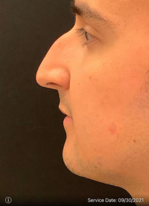 Rhinoplasty