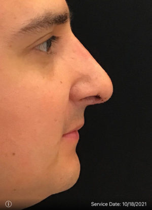 Rhinoplasty