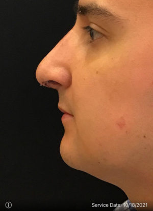 Rhinoplasty